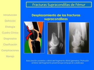 Fracturas Supracondilias de Fémur

 Introducción          Desplazamiento de las fracturas
                              supracondíleas
  Definición

   Etiología

Cuadro Clínico

 Diagnostico

 Clasificación

Complicaciones

   Manejo
                 Basculación posterior y distal del fragmento distal (gemelos). Protrusión
                      anterior del fragmento proximal que empuja al cuádriceps
 