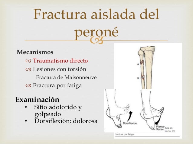 Fracturas de Tibia y peroné