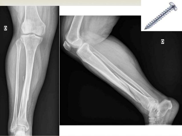 Fracturas de Tibia y peroné