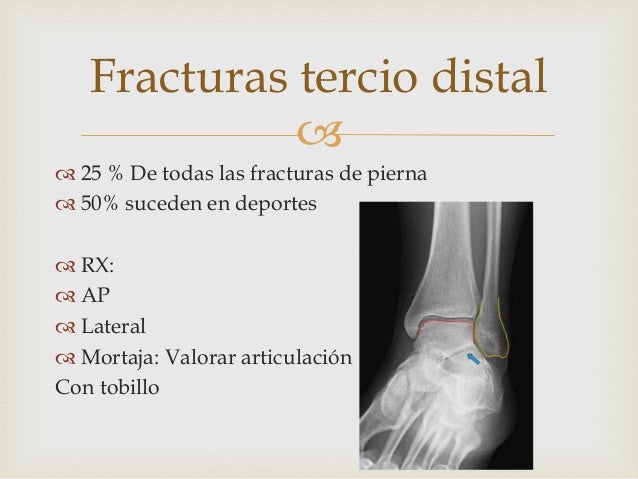Fracturas de Tibia y peroné