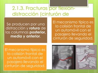 2.1.3. Fracturas por flexión-
distracción (cinturón de
seguridad)
Se producen por una
distracción y rotura de
las columnas posterior,
media y anterior.
El mecanismo típico es
la colisión frontal de
un automóvil con el
pasajero llevando el
cinturón de seguridad.
El mecanismo típico es
la colisión frontal de
un automóvil con el
pasajero llevando el
cinturón de seguridad.
 