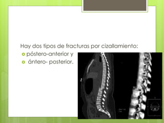 Hay dos tipos de fracturas por cizallamiento:
 póstero-anterior y
 ántero- posterior.
 