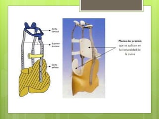 Fracturas toracolumbares