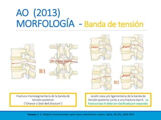 AO (2013)
MORFOLOGÍA - Banda de tensión
Vaccaro, A. R. AOSpine thoracolumbar spine injury classification system. Spine, 38 (23), 2028-2037.
Lesión osea y/o ligamentaria de la banda de
tensión posterior junto a una fractura tipo A. La
fractura tipo A debe ser clasificada por separado.
Fractura monosegmentaria de la banda de
tensión posterior
(“Chance o Seat Belt fracture”)
 