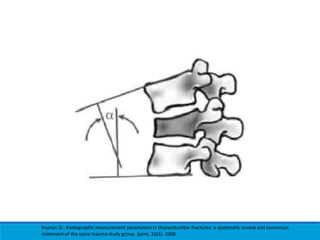 Keynan O.: Radiographic measurement parameters in thoracolumbar fractures: a systematic review and consensus
statement of the spine trauma study group. Spine, 31(5). 2006.
 