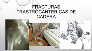 FRACTURAS
TRASTROCANTERICAS DE
CADERA
 