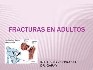 FRACTURAS EN ADULTOS
INT. LISLEY ACHACOLLO
DR. GARAY
 