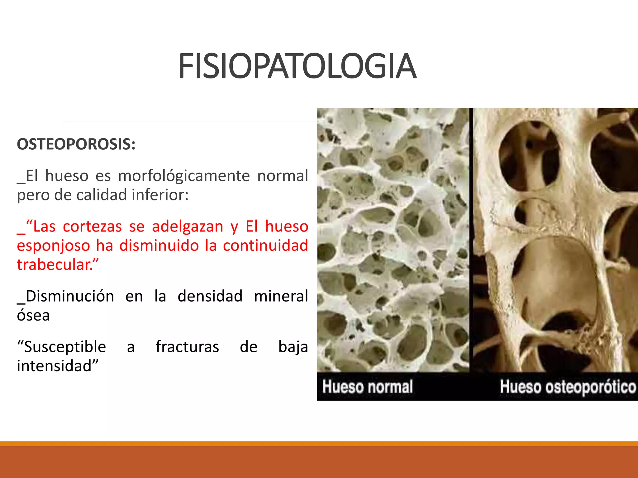 Fracturas vertebrales osteoporoticas | PPTX