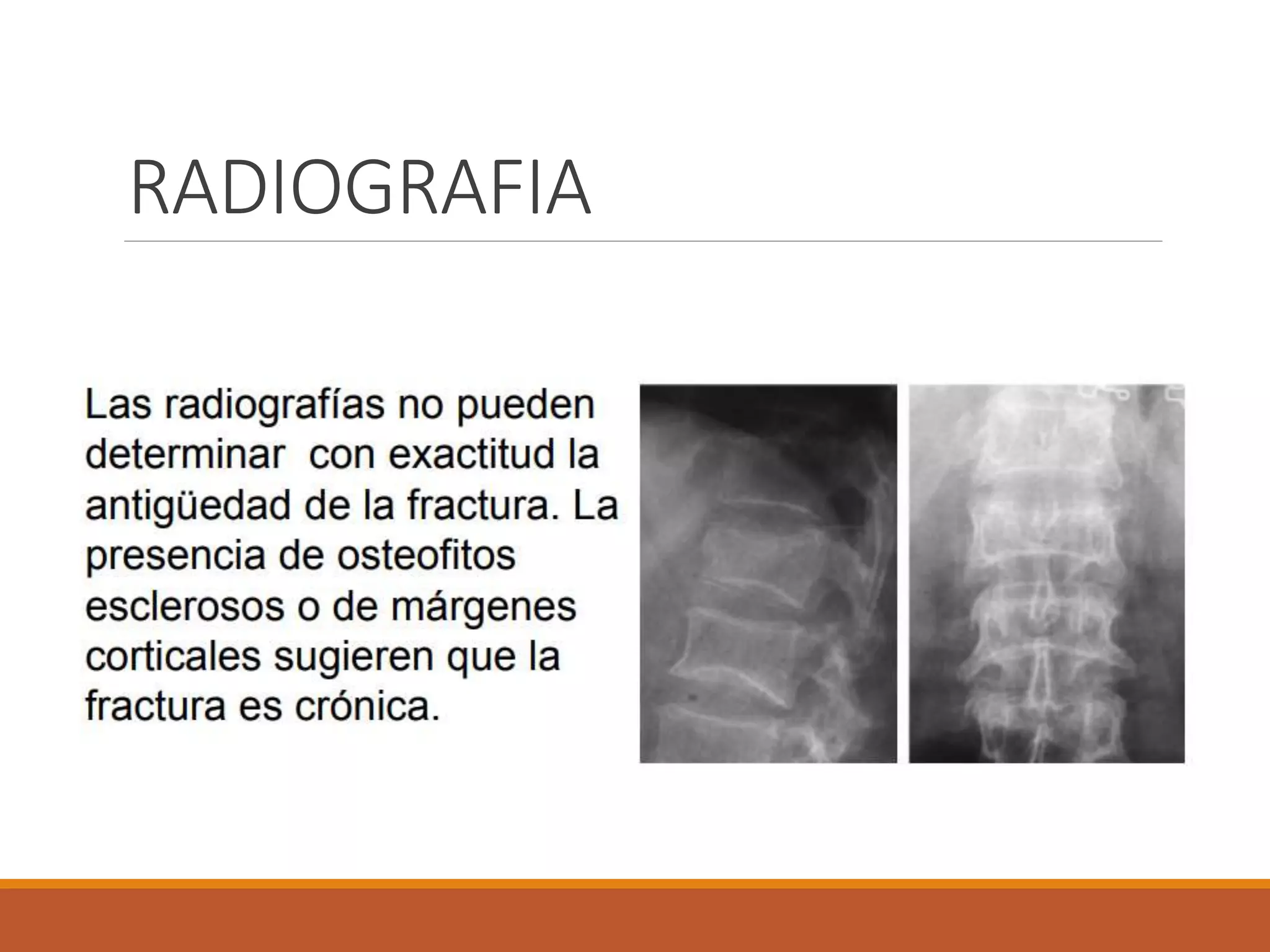 Fracturas vertebrales osteoporoticas | PPTX