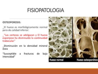FISIOPATOLOGIA
OSTEOPOROSIS:
_El hueso es morfológicamente normal
pero de calidad inferior:
_“Las cortezas se adelgazan y El hueso
esponjoso ha disminuido la continuidad
trabecular.”
_Disminución en la densidad mineral
ósea
“Susceptible a fracturas de baja
intensidad”
 