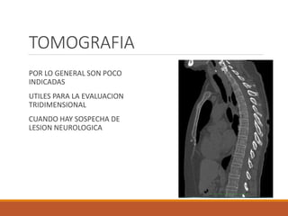 TOMOGRAFIA
POR LO GENERAL SON POCO
INDICADAS
UTILES PARA LA EVALUACION
TRIDIMENSIONAL
CUANDO HAY SOSPECHA DE
LESION NEUROLOGICA
 