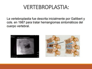 VERTEBROPLASTIA:
 
