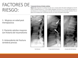 FACTORES DE
RIESGO:
1. Mujeres en edad post
menopaúsica
2. Paciente adultos mayores
con historia de traumatismo
3. Antecedente de fractura
vertebral previas
 