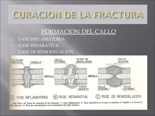 FORMACION DEL CALLO FASE INFLAMATORIA FASE REPARATIVA FASE DE REMODELACION 