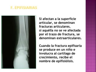 F. EPIFISIARIAS
Si afectan a la superficie
articular, se denominan
fracturas articulares.
si aquélla no se ve afectada
por el trazo de fractura, se
denominan extraarticulares.
Cuando la fractura epifisaria
se produce en un niño e
involucra al cartílago de
crecimiento, recibe el
nombre de epifisiólisis.
 