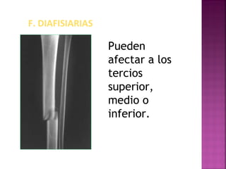 F. DIAFISIARIAS
Pueden
afectar a los
tercios
superior,
medio o
inferior.
 