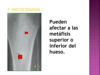 F. METAFISIARIAS
Pueden
afectar a las
metáfisis
superior o
inferior del
hueso.
 