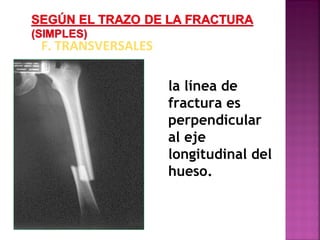F. TRANSVERSALES
la línea de
fractura es
perpendicular
al eje
longitudinal del
hueso.
 