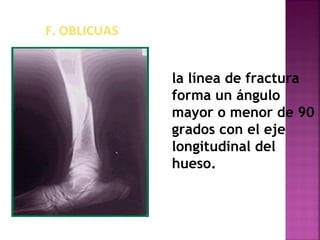 F. OBLICUAS
la línea de fractura
forma un ángulo
mayor o menor de 90
grados con el eje
longitudinal del
hueso.
 