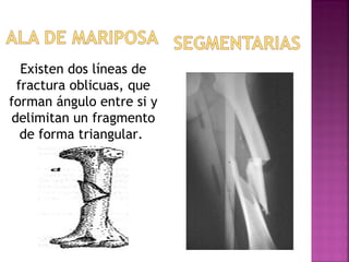 Existen dos líneas de
fractura oblicuas, que
forman ángulo entre si y
delimitan un fragmento
de forma triangular.
 