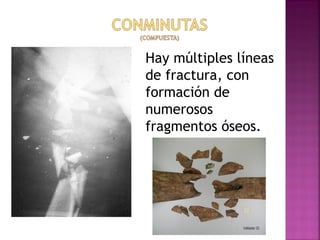 Hay múltiples líneas
de fractura, con
formación de
numerosos
fragmentos óseos.
 