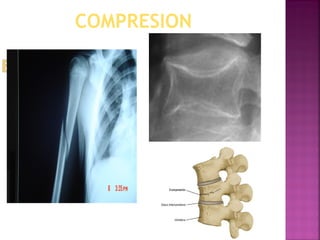COMPRESION
 