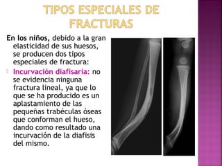 En los niños, debido a la gran
elasticidad de sus huesos,
se producen dos tipos
especiales de fractura:
 Incurvación diafisaria: no
se evidencia ninguna
fractura lineal, ya que lo
que se ha producido es un
aplastamiento de las
pequeñas trabéculas óseas
que conforman el hueso,
dando como resultado una
incurvación de la diafisis
del mismo.
 