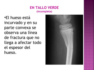 EN TALLO VERDE
(incompleta)
•El hueso está
incurvado y en su
parte convexa se
observa una línea
de fractura que no
llega a afectar todo
el espesor del
hueso.
 