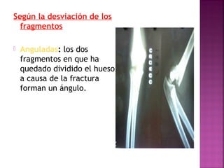 Según la desviación de los
fragmentos
 Anguladas: los dos
fragmentos en que ha
quedado dividido el hueso
a causa de la fractura
forman un ángulo.
 