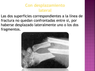 Con desplazamiento
lateral
Las dos superficies correspondientes a la línea de
fractura no quedan confrontadas entre si, por
haberse desplazado lateralmente uno o los dos
fragmentos.
 