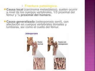  Fractura patológica.
 Causa local (carcinoma metastásico), suelen ocurrir
a nivel de los cuerpos vertebrales, 1/3 proximal del
fémur y ½ proximal del húmero.
 Causa generalizada (osteoporosis senil), con
afectación en cuerpos vertebrales dorsales y
lumbares, así como el cuello del fémur.
 