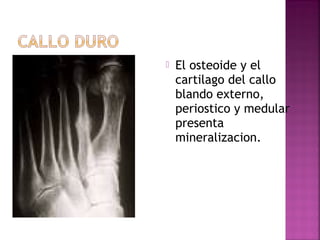  El osteoide y el
cartilago del callo
blando externo,
periostico y medular
presenta
mineralizacion.
 