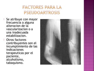  Se atribuye con mayor
frecuencia a alguna
alteracion de la
vascularizacion o a
una inadecuada
estabilizacion.
 Otros factores
contribuyentes son el
incumplimiento de las
indicaciones
terapeuticas por el
paciente,
alcoholismo,
tabaquismo.
 