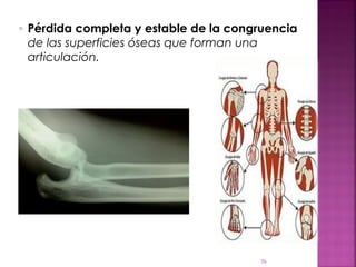 56
◦ Pérdida completa y estable de la congruencia
de las superficies óseas que forman una
articulación.
 