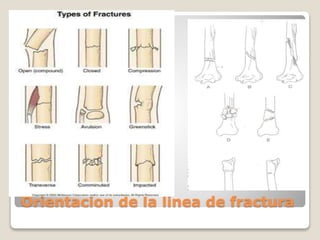 Orientacion de la linea de fractura
 