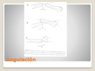 Angulación
 