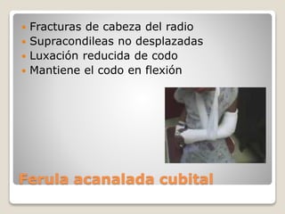 Ferula acanalada cubital
 Fracturas de cabeza del radio
 Supracondileas no desplazadas
 Luxación reducida de codo
 Mantiene el codo en flexión
 