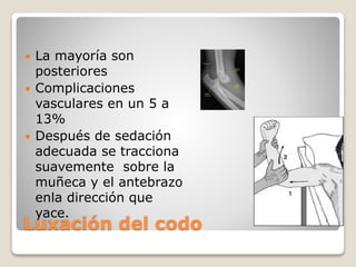 Luxación del codo
 La mayoría son
posteriores
 Complicaciones
vasculares en un 5 a
13%
 Después de sedación
adecuada se tracciona
suavemente sobre la
muñeca y el antebrazo
enla dirección que
yace.
 