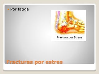 Fracturas por estres
 Por fatiga
 