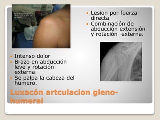 Luxacón artculacion gleno-
humeral
 Intenso dolor
 Brazo en abducción
leve y rotación
externa
 Se palpa la cabeza del
humero.
 Lesion por fuerza
directa
 Combinación de
abducción extensión
y rotación externa.
 