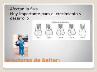 Fracturas de Salter:
 Afectan la fisis
 Muy importante para el crecimiento y
desarrollo
 