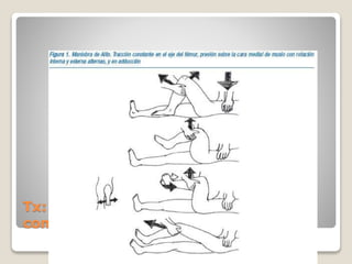 Tx: Reduccion cerrada bajo sedación
conciente o anestesia general
 