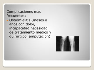 Complicaciones mas
frecuentes:
 Ostiomielitis (meses o
años con dolor,
incapacidad necesidad
de tratamiento medico y
quirurgico, amputacion)
 