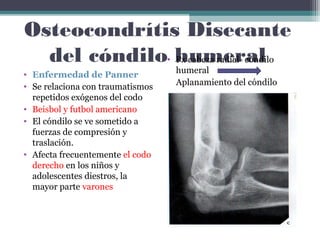 Osteocondrítis Disecante
  del cóndilo• humeral
               Px cabeza radial- cóndilo
• Enfermedad de Panner            humeral
• Se relaciona con traumatismos   Aplanamiento del cóndilo
  repetidos exógenos del codo
• Beisbol y futbol americano
• El cóndilo se ve sometido a
  fuerzas de compresión y
  traslación.
• Afecta frecuentemente el codo
  derecho en los niños y
  adolescentes diestros, la
  mayor parte varones
 