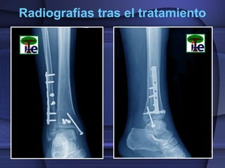 Radiografías tras el tratamiento