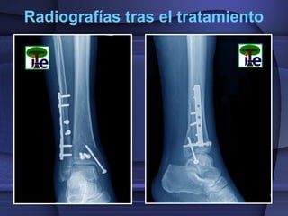 Radiografías tras el tratamiento

 