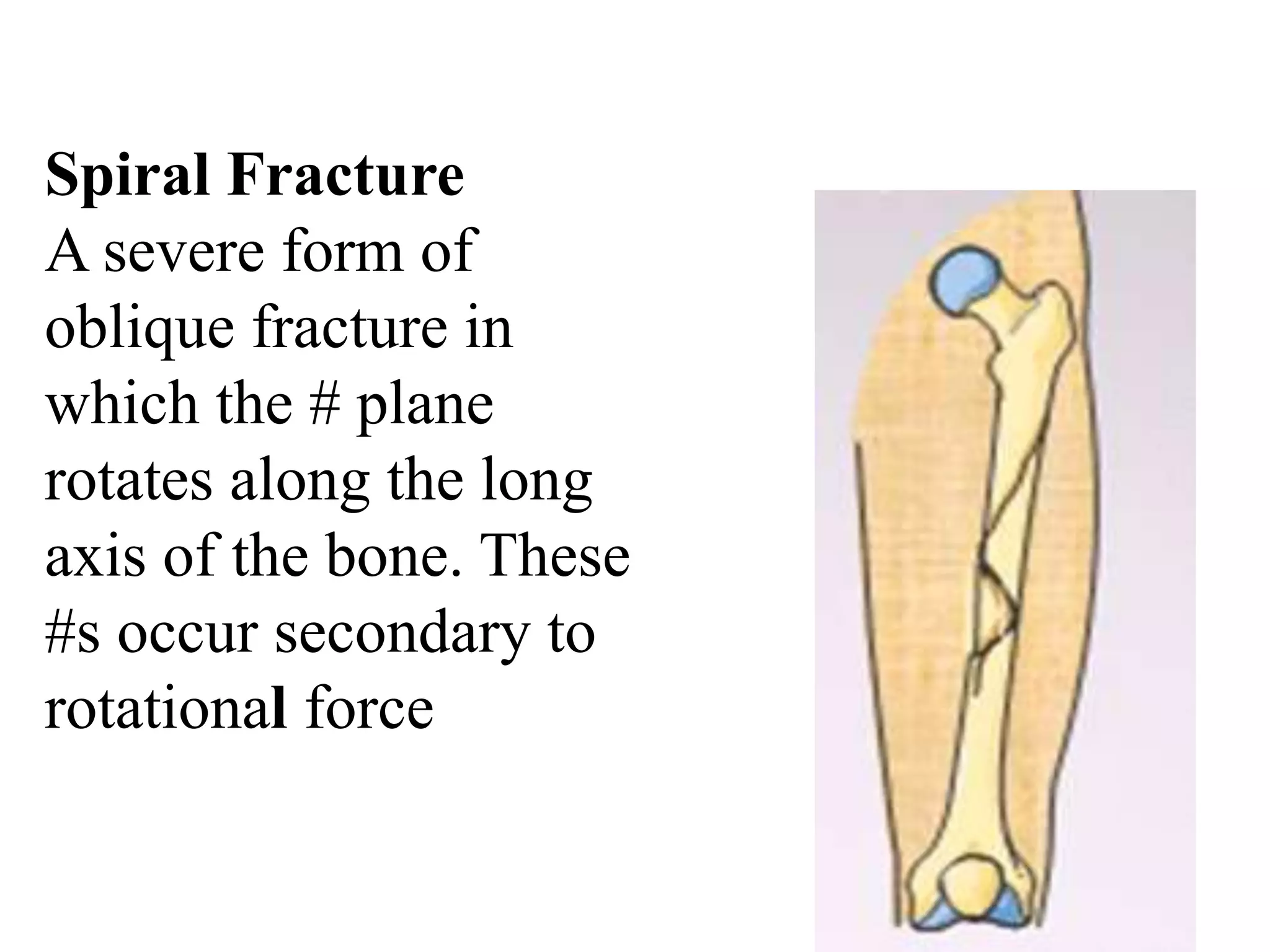 Spiral Fracture
A severe form of
oblique fracture in
which the # plane
rotates along the long
axis of the bone. These
#s occur secondary to
rotational force
 