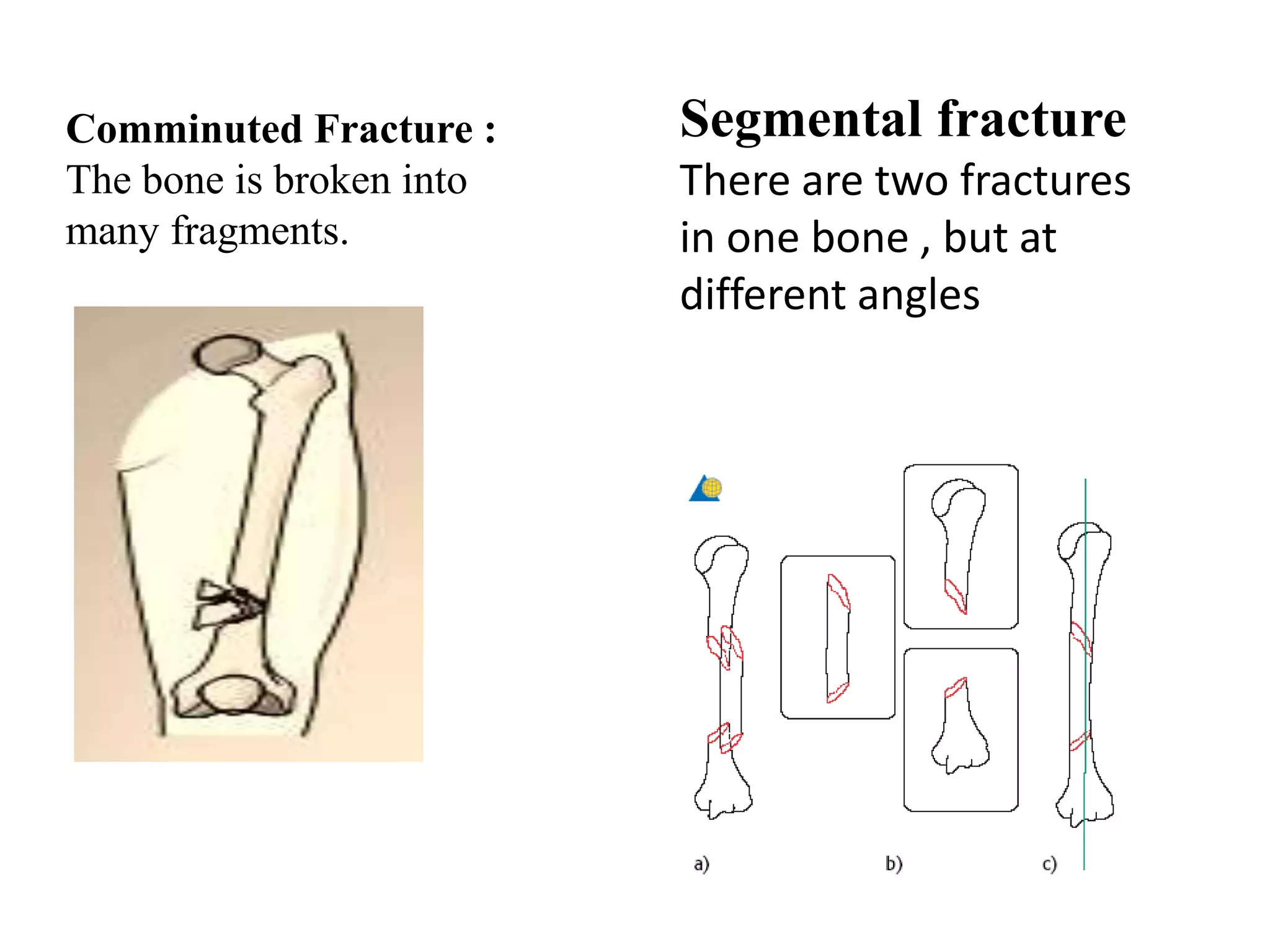 Comminuted Fracture :
The bone is broken into
many fragments.
Segmental fracture
There are two fractures
in one bone , but at
different angles
 