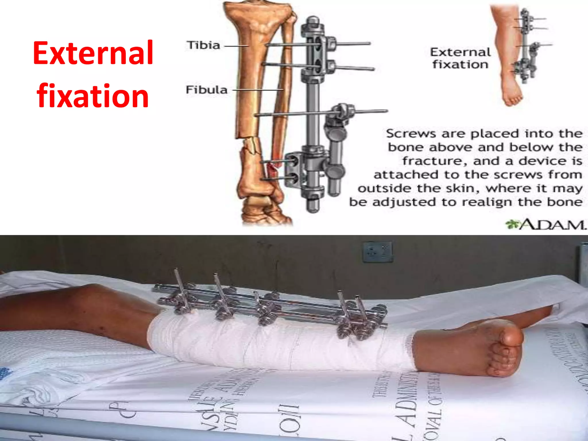 External
fixation
 