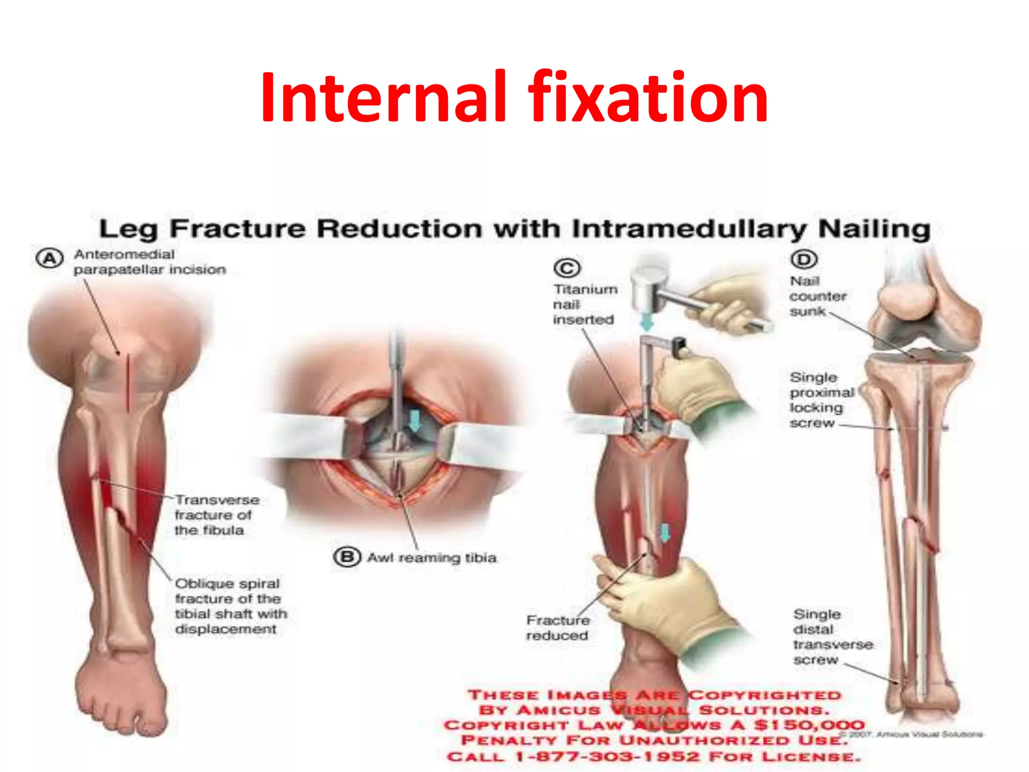 Internal fixation
 